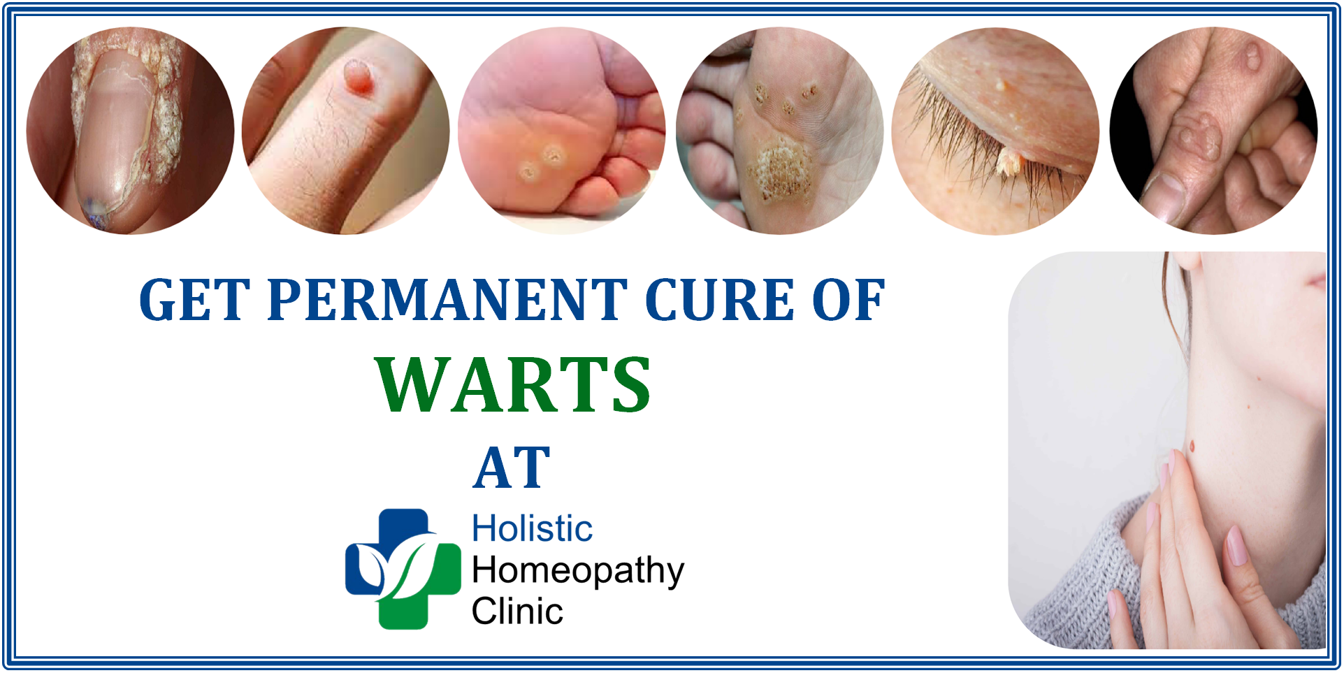 Warts Holistic Homeopathy